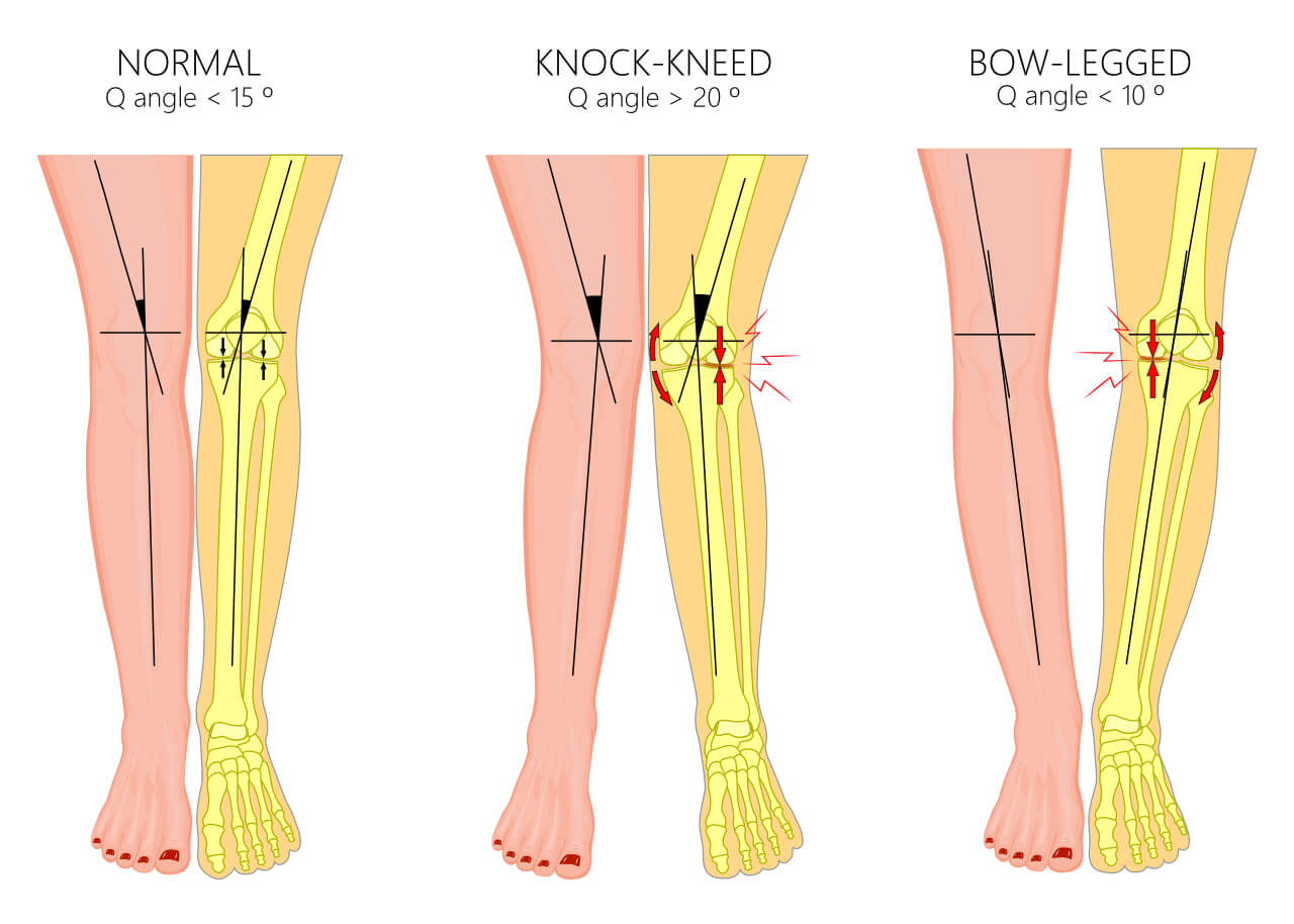 An Introduction to Gait and Gait Abnormalities - AposHealth®