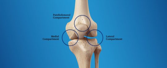 tricompartmental osteoarthritis diagram